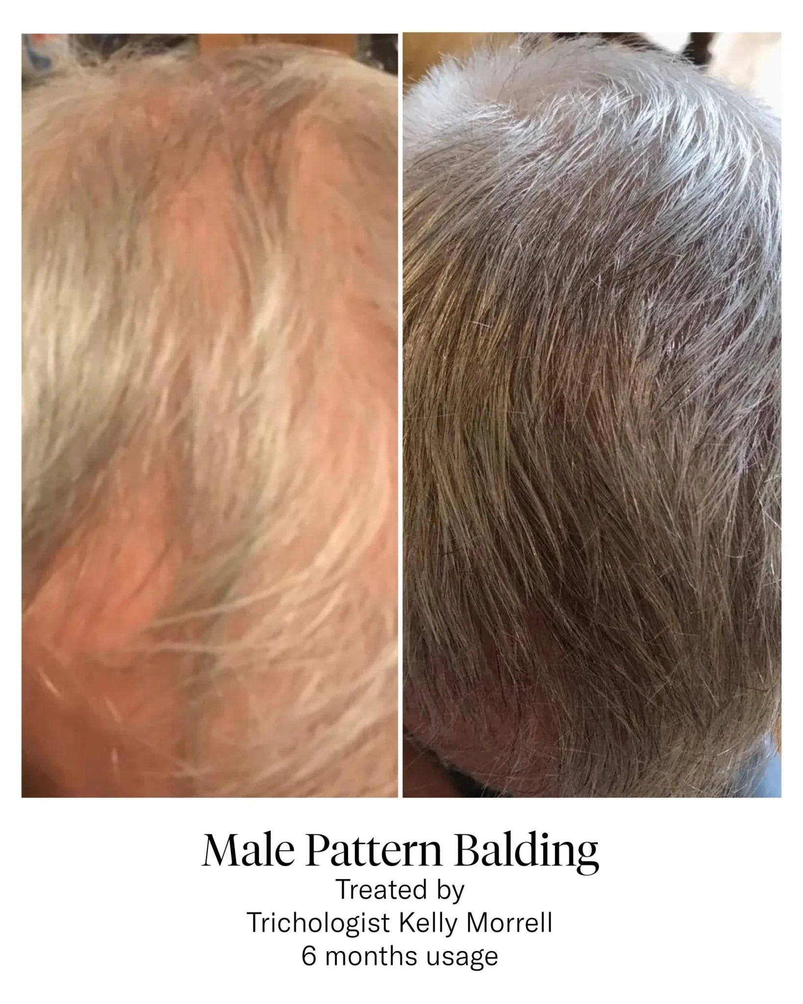 Calecim Professional Advanced Hair System - Image 5