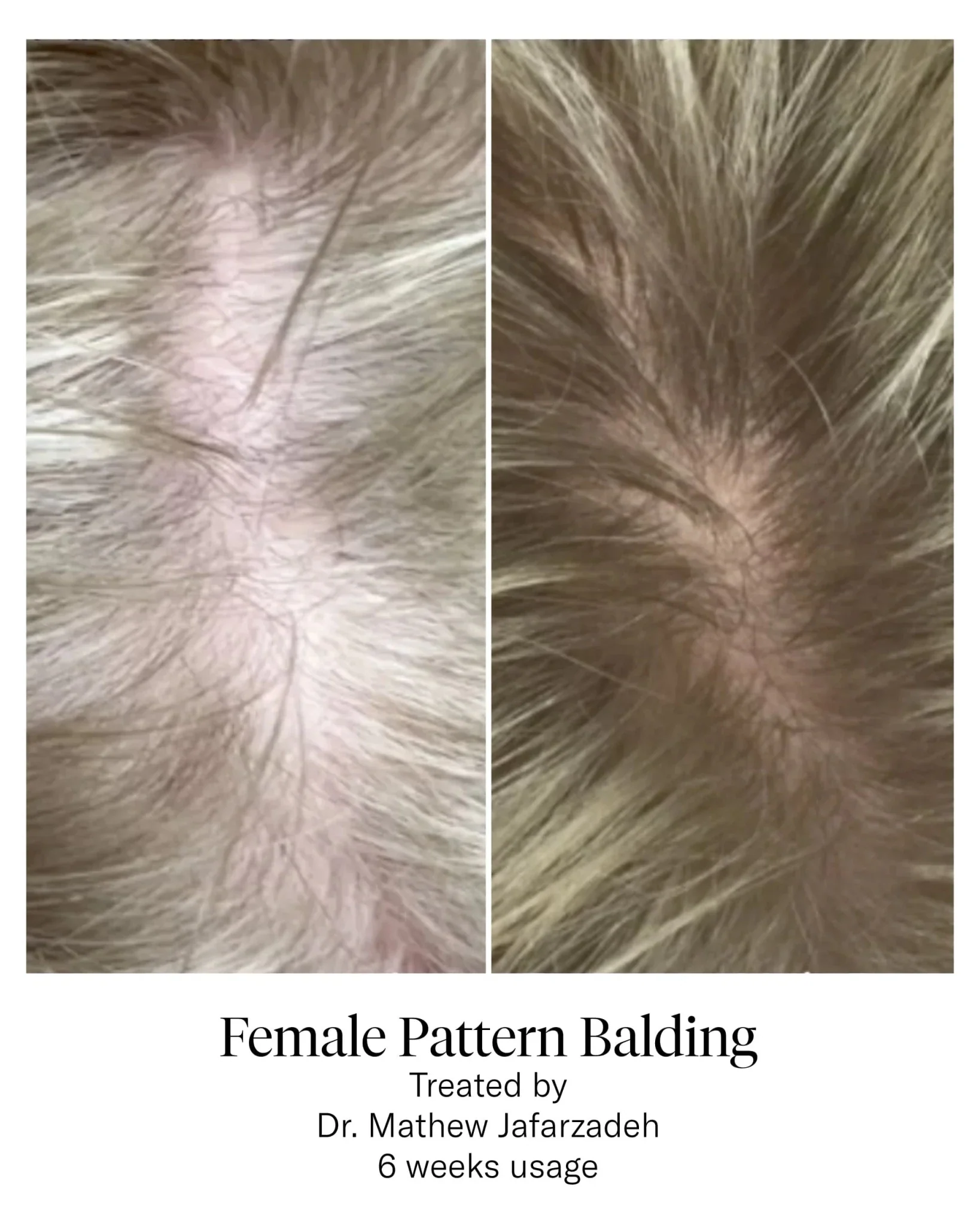 Calecim Professional Advanced Hair System - Image 7