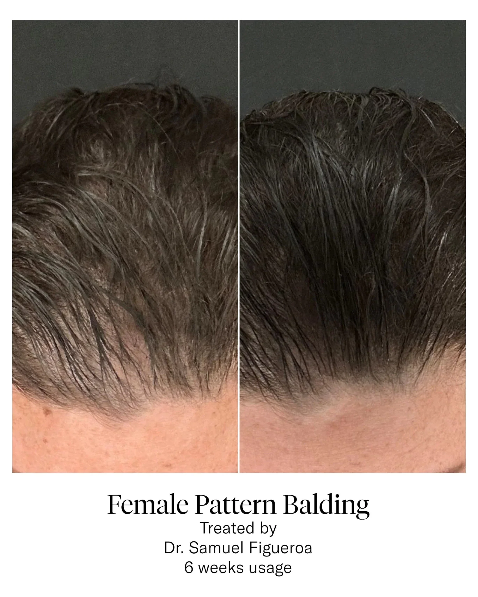 Calecim Professional Advanced Hair System - Image 9