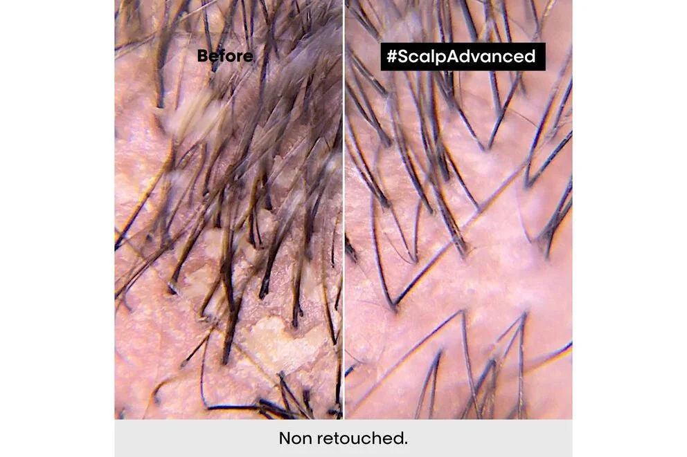 L'Oréal Professionnel Scalp Advanced Anti-Dandruff Shampoo 300ml - Image 3