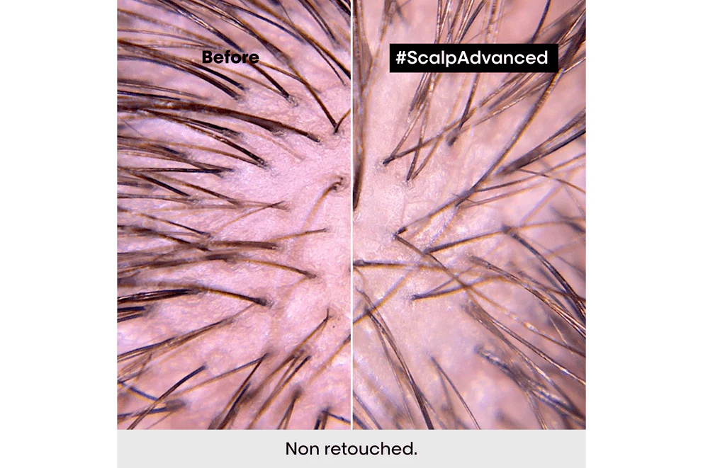 L'Oréal Professionnel Scalp Advanced Anti-Discomfort Treatment 200ml - Image 6